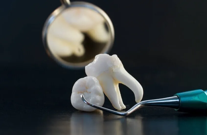 اكتشاف تأثير غير متوقع لقلع أضراس العقل